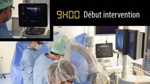 video Anévrisme abdominal en ambulatoire